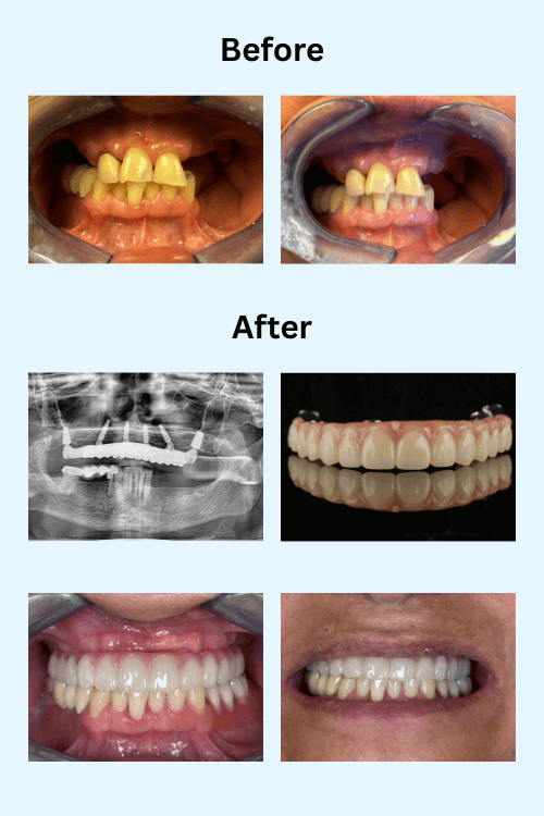 Before and after dental implant prosthesis result